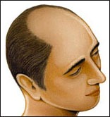 alopecia androgenetica